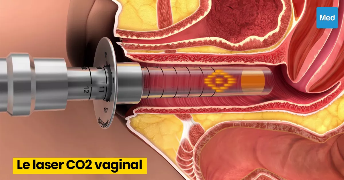 Le laser CO2 vaginal : une solution non invasive pour améliorer la santé et le bien-être intimes